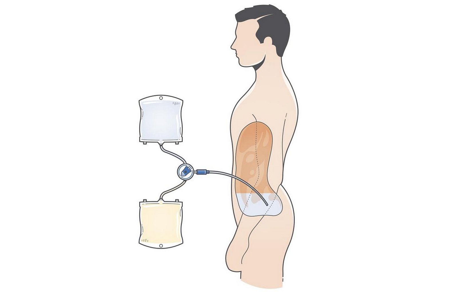 Para quem é que a diálise peritoneal é a melhor opção? Drawing of peritoneal dialysis treatment